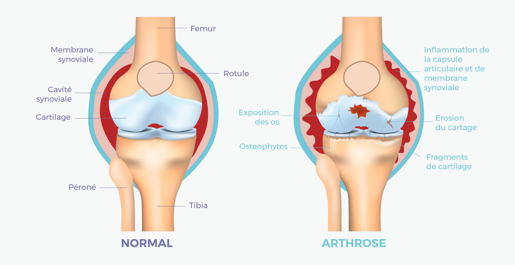Arthrose